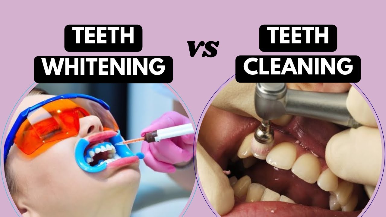 TEETH WHITENING vs TEETH CLEANING What's the difference? YouTube