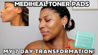 Mediheal Blemish Pad: My 7-Day Skin Transformation | Black Skin Results screenshot 3