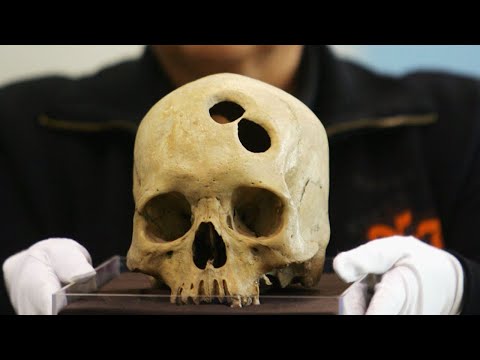 Video: ¿Qué hace la trepanación?