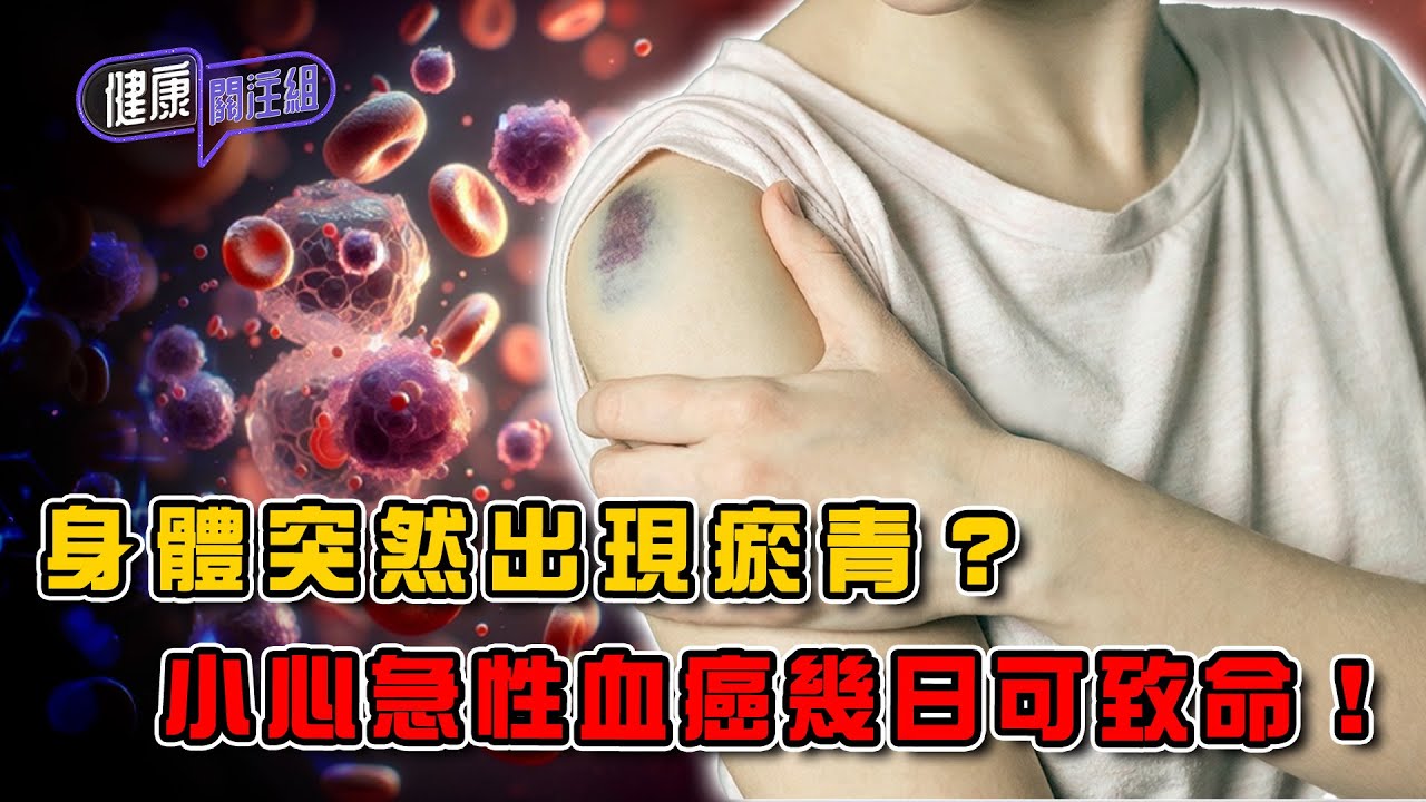 身體突然出現瘀青？小心急性血癌幾日可致命！｜ 健康關注組 ｜ EP406 ｜ 血癌 ｜ 白血病 ｜敖嘉年 ｜ 麥詩敏 ｜ HOY TV 77台