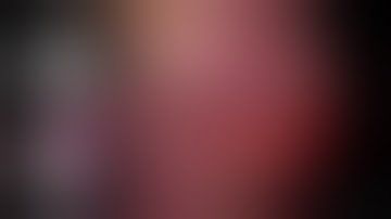 uniportal VATS Right S6 + S6*(subsuperior) segmentectomy