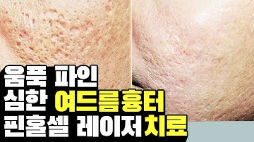 흉터만 치료하는 서정권원장님이 직접 치료한 움푹 파인 심한 여드름 흉터!! acne scar treatment  - 핀홀셀 레이저치료