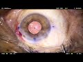 Live Cataract Surgery with TECNIS Toric IOL by Dr. Gaurav Luthra