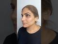 Коррекция подбородка и носослезеой борозды #косметолог #ботокс #botox #лифтинг #био  #мезо #топ