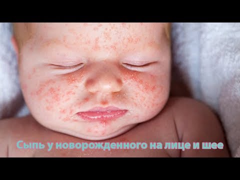 Сыпь у новорожденного на лице и шее