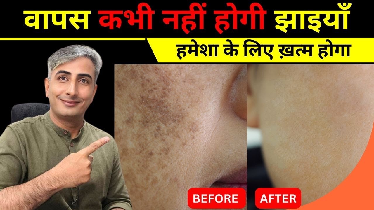 वापस कभी नहीं होगी झाइयाँ   Pigmentation Treatment at Home   Dr  Manoj Das