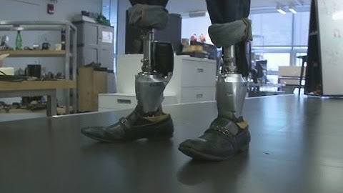 Bionic limbs transform lives