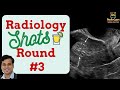 Tamoxifen-associated Cystic Endometrial Hyperplasia | Short Radiology Cases | Round 3