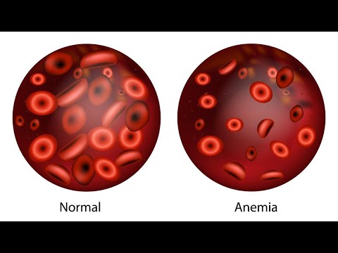 Anemia: Definisi, Klasifikasi, Jenis, Gejala, Stadium Klinis, Diagnosa/Metode Pemeriksaan Anemia