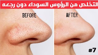 افضل طريقه للتخلص من الرؤوس السوداء نهائيا؟ #blackheads #blackhead #blackheadremoval