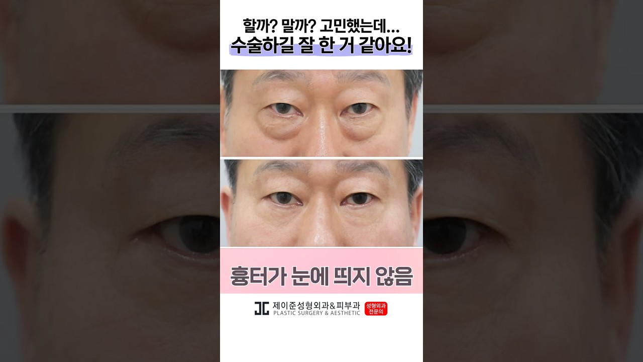 [제이준 성형외과 피부] Tôi đã trẻ lại 10 tuổi chỉ sau một lần phẫu thuật!😆 #shorts