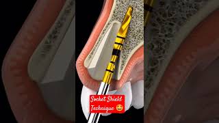 Socket Shield Technique #dentalhealthtips #implants #dentalimplants #implantdentistry #implantologie Socket Shield Technique #dentalhealthtips #implants #dentalimplants #implantdentistry #implantologie