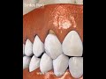 Dental Abfraction/ Abfraccion dental