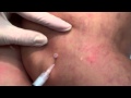 Sclerotherapy with treatment of reticular veins.mp4