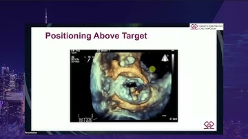 SUN 11 20 Charles Nyman – Essential Imaging for MV SHD Interventions MPR