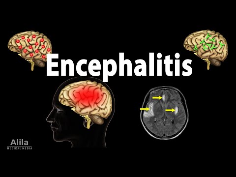 Video: Bagaimana untuk merawat ensefalitis?