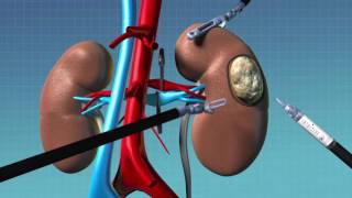 Treating Kidney Cancer