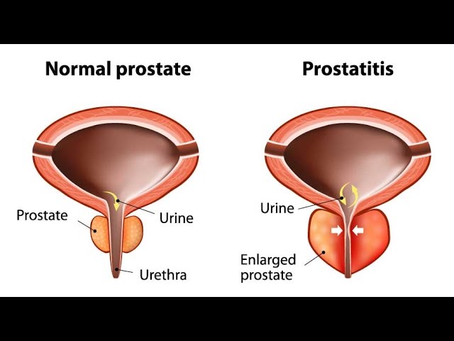 Prostatitis a férfi veseben