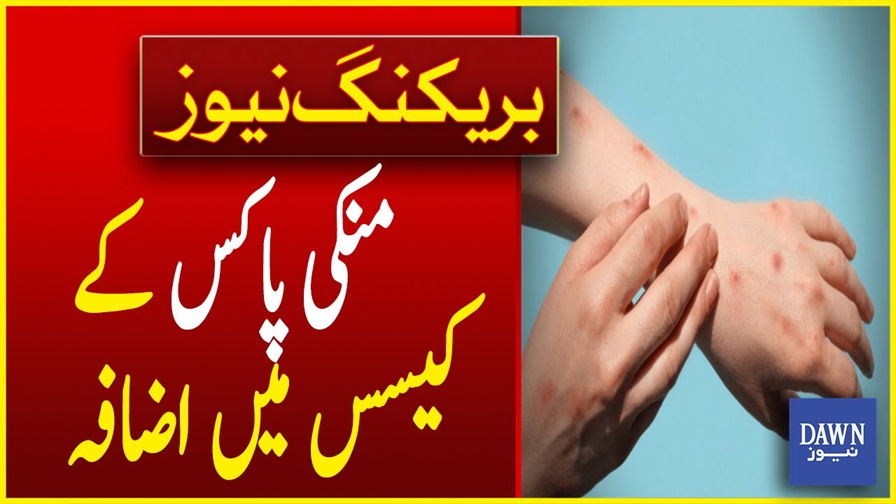 3rd Case of Monkeypox Emerges in Pakistan | Breaking News | Dawn News ...
