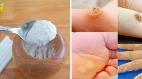 Virus mụn cóc biến mất mãi mãi. Các bác sĩ bị sốc 💥