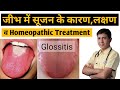 Glossitis ज भ म स जन क क रण लक षण व इल ज Glossitis Homeopathic Treatment Glossitis Tongue Glossitis ज भ म स जन क क रण लक षण व इल ज Glossitis Homeopathic Treatment Glossitis Tongue