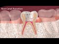 Pain Free - Root canal Treatment