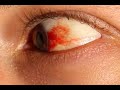 【結膜下出血】白目が出血しているけど大丈夫?