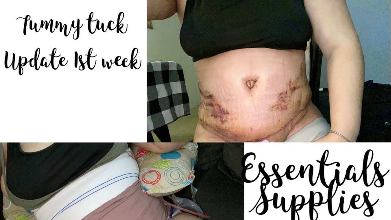 my tummy tuck journey