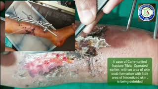 Wound Care Tips Post-Op Wound Care Ex-Fix Care Post-Op Wound Scab Removal Adamya Hospital Vd