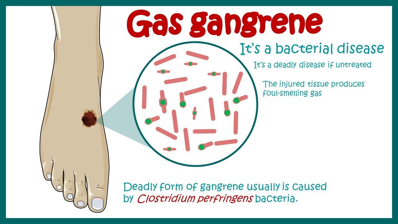 Gas Gangrene |  Clostridial Myonecrosis | Symptoms and treatment of Gas Gangrene