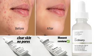 Ordinary Niacinamide And Zinc Serum Honest Review By Hs World 