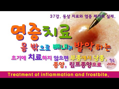 염증치료 37강. 동상 치료와 염증 제거의 실제. 염증은 인체의 쓰레기장. Treatment of inflammation and frostbite.