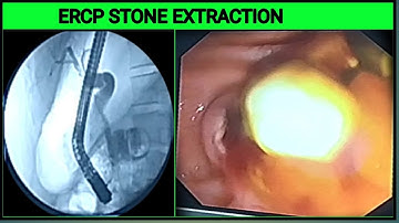 ERCP Stone Extraction #BD_ENDOSCOPY