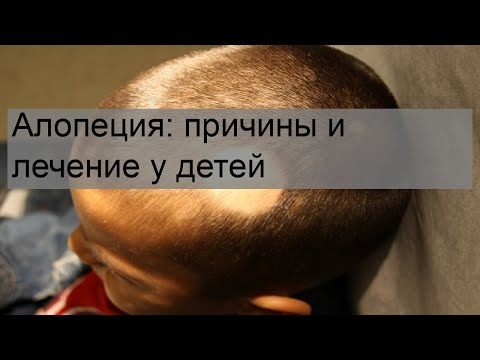 Алопеция: причины и лечение у детей