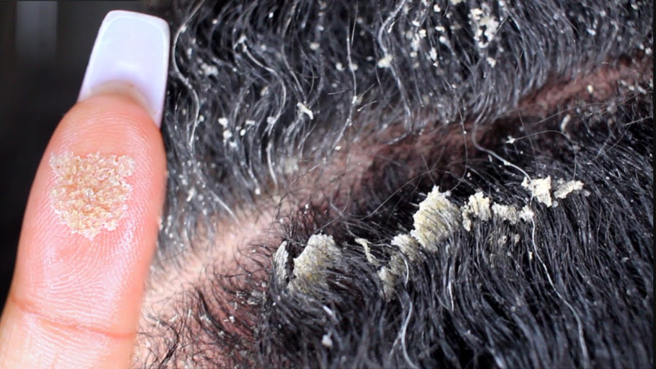 huge patches of dandruff removal videos Litomoil pikkelysömör kezelésére