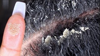 MY BIGGEST FLAKES EVER PART 2 | Scalp scratching and picking | Satisfying Dandruff Removal ASMR