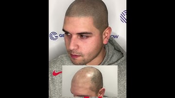 Bad ScalpMicropigmentation Fixed