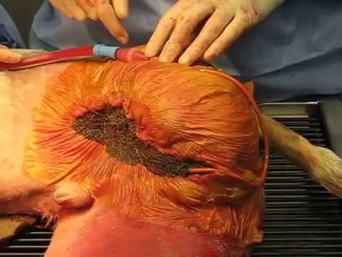 ​Vacuum-Assisted Closure for Wound Healing