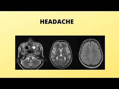 patient with headache & MRI Brain