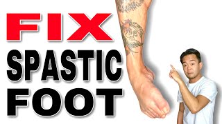 Fix a Spastic Foot Stretches and Exercises | Occupational Therapy