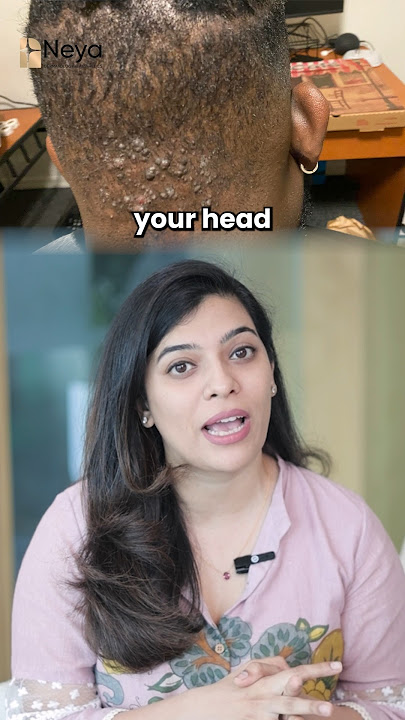 Bumps on back of the neck | How to treat bump on head #shorts