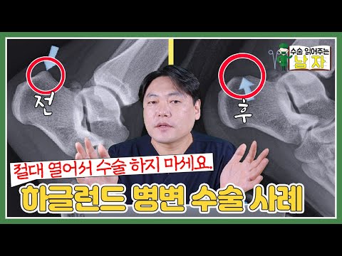 [운동선수 수술 케이스] 🚨몇 번 강조 드립니다. 하글런드 절.대. 열지 마세요. 🚨 하글런드 내시경 수술 케이스｜수술 읽어주는 남자👨‍⚕️