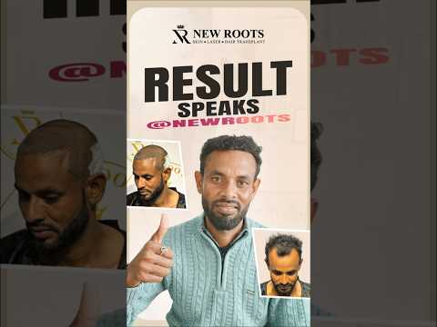 Patient Review: Hair Transplant in Siliguri | Cost & Results #hairtransplant #siliguri #shorts