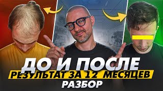 видео: До и после | Реальный результат лечения и пересадки волос! картинка: До и после | Реальный результат лечения и пересадки волос!