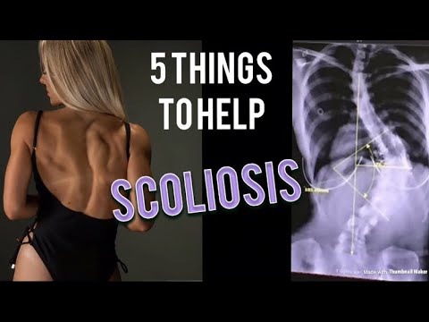 Image Kode Icd X Scoliosis