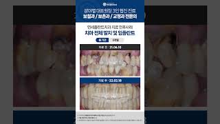 연세플란트치과 치아 전체 발치 및 임플란트 식립 치료 전후사례입니다.