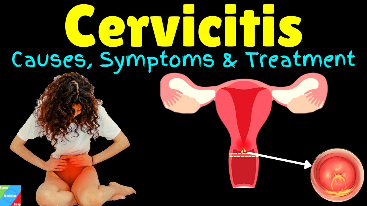case study 64 cervicitis answers