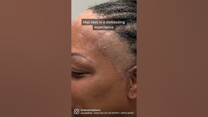 Hair loss/ Alopecia Help