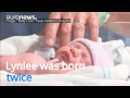 Meet the miracle baby who was 'born twice'