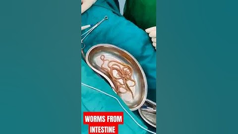Cacing Dikeluarkan Dari Usus #cacing #ascari #cacing kremi #ascaris #dokter bedah